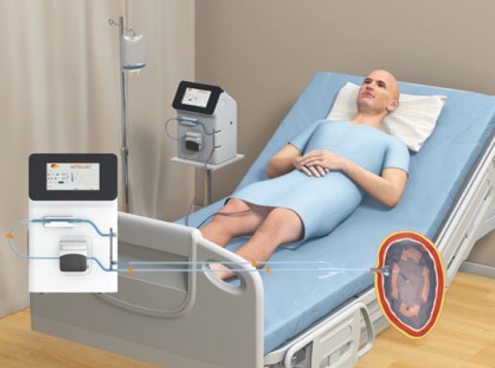 Cancer de la vessie traitement, Combat BRS, Thermotherapie Surgynal